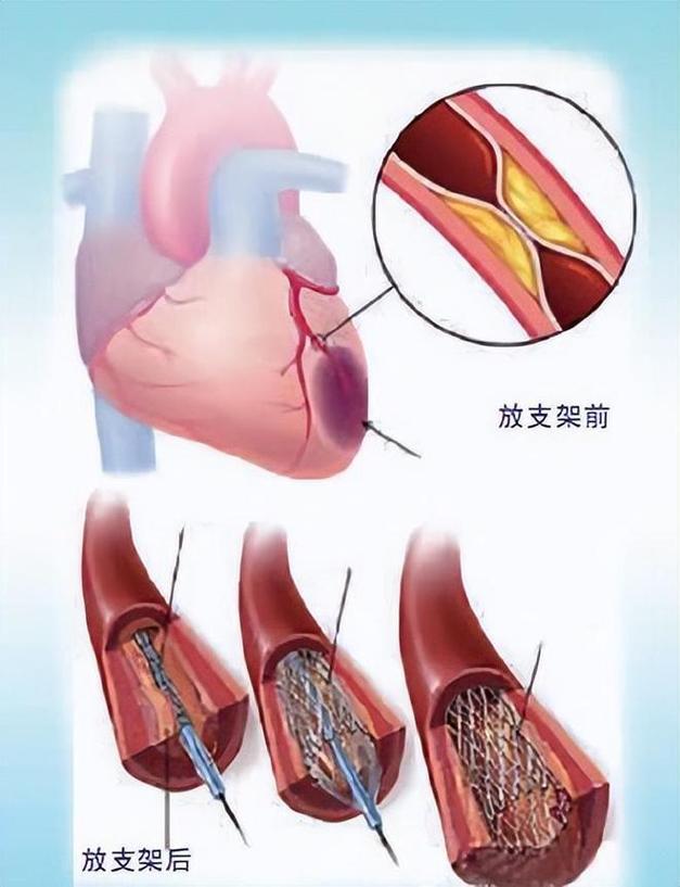 心脏支架手术后遗症有哪些