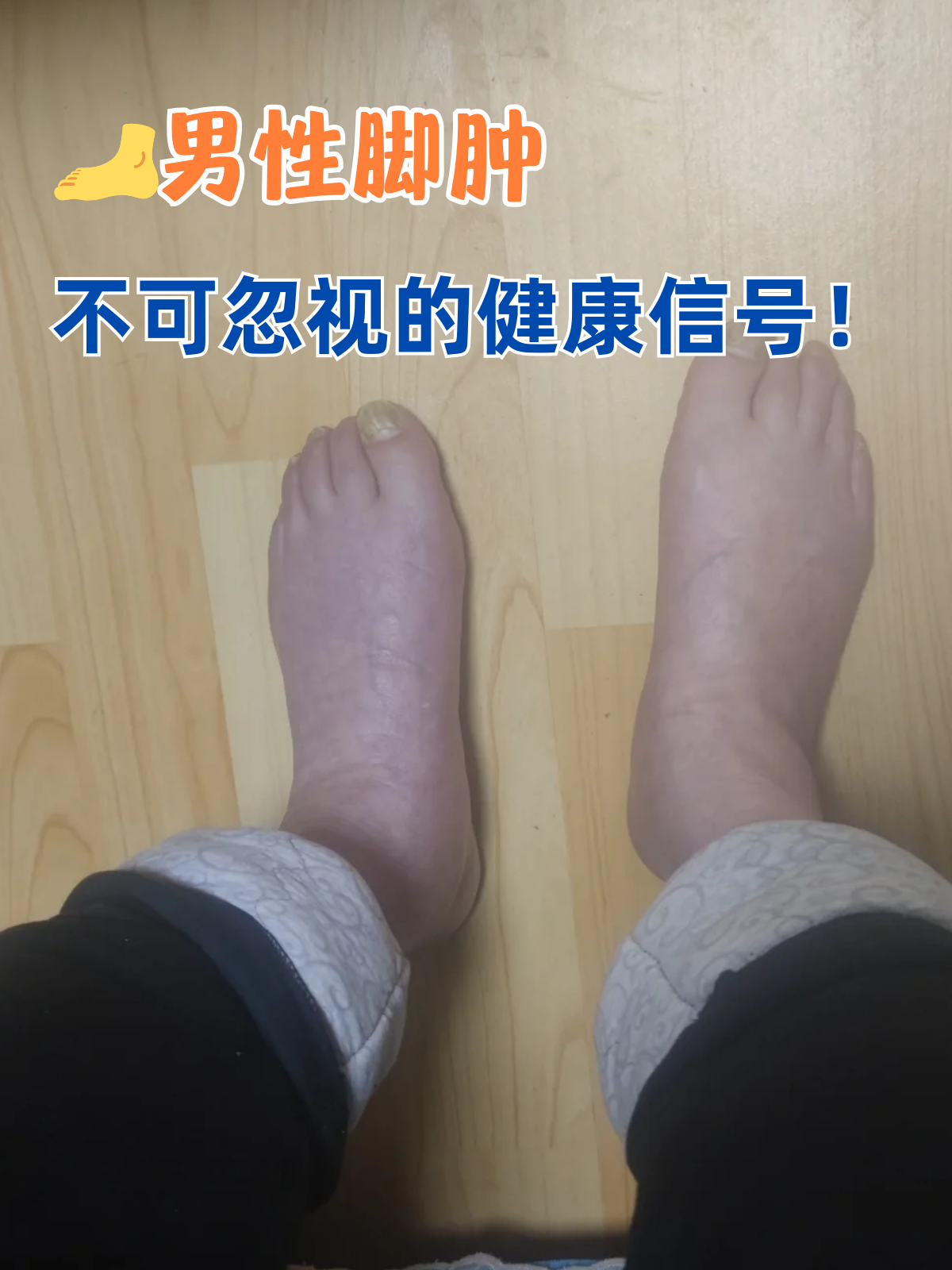 80多岁老人脚肿什么病