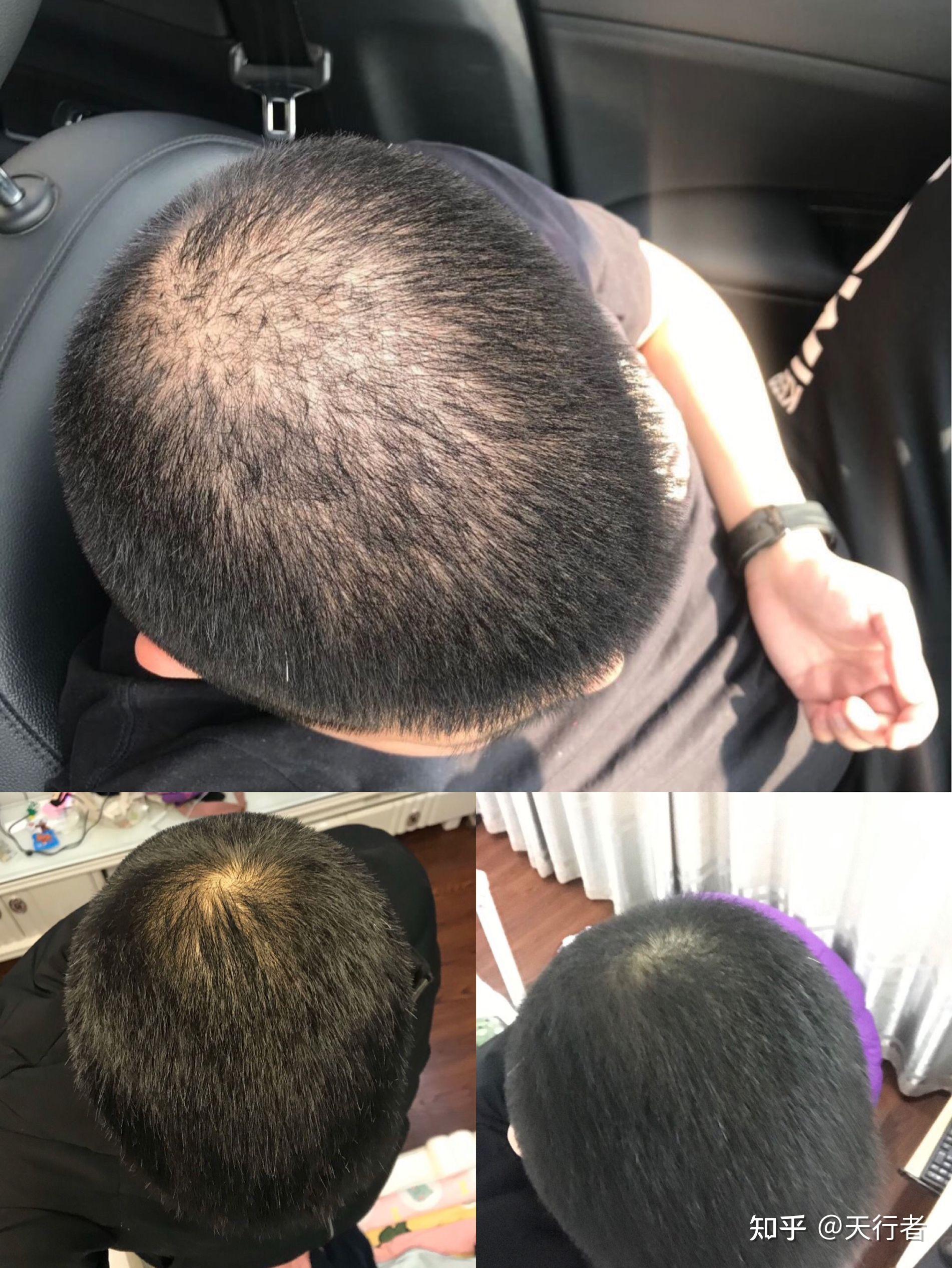 经常脱发是缺什么