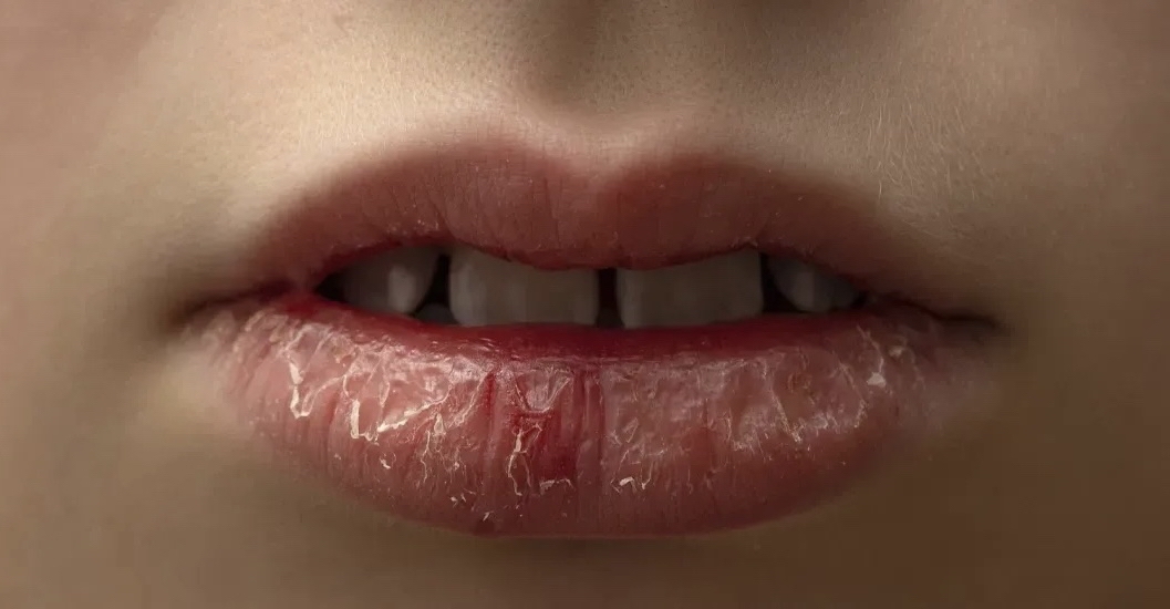 嘴角干裂如何治疗