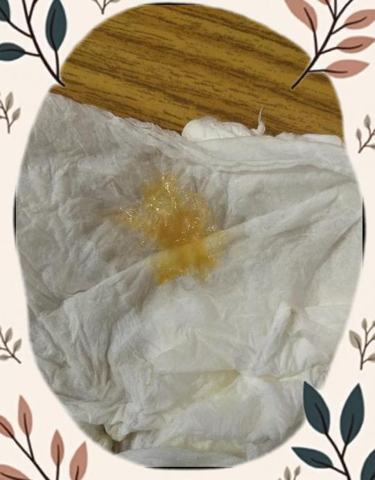 鼻子里老有黄鼻涕很稠是什么