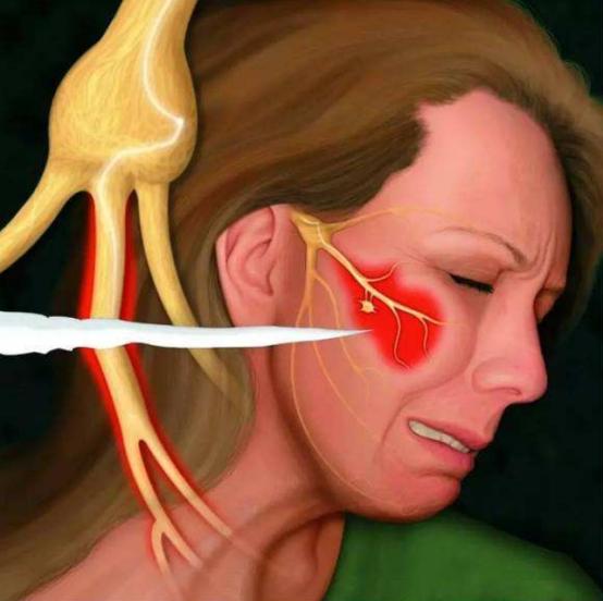 三叉神经痛症状表现有哪些