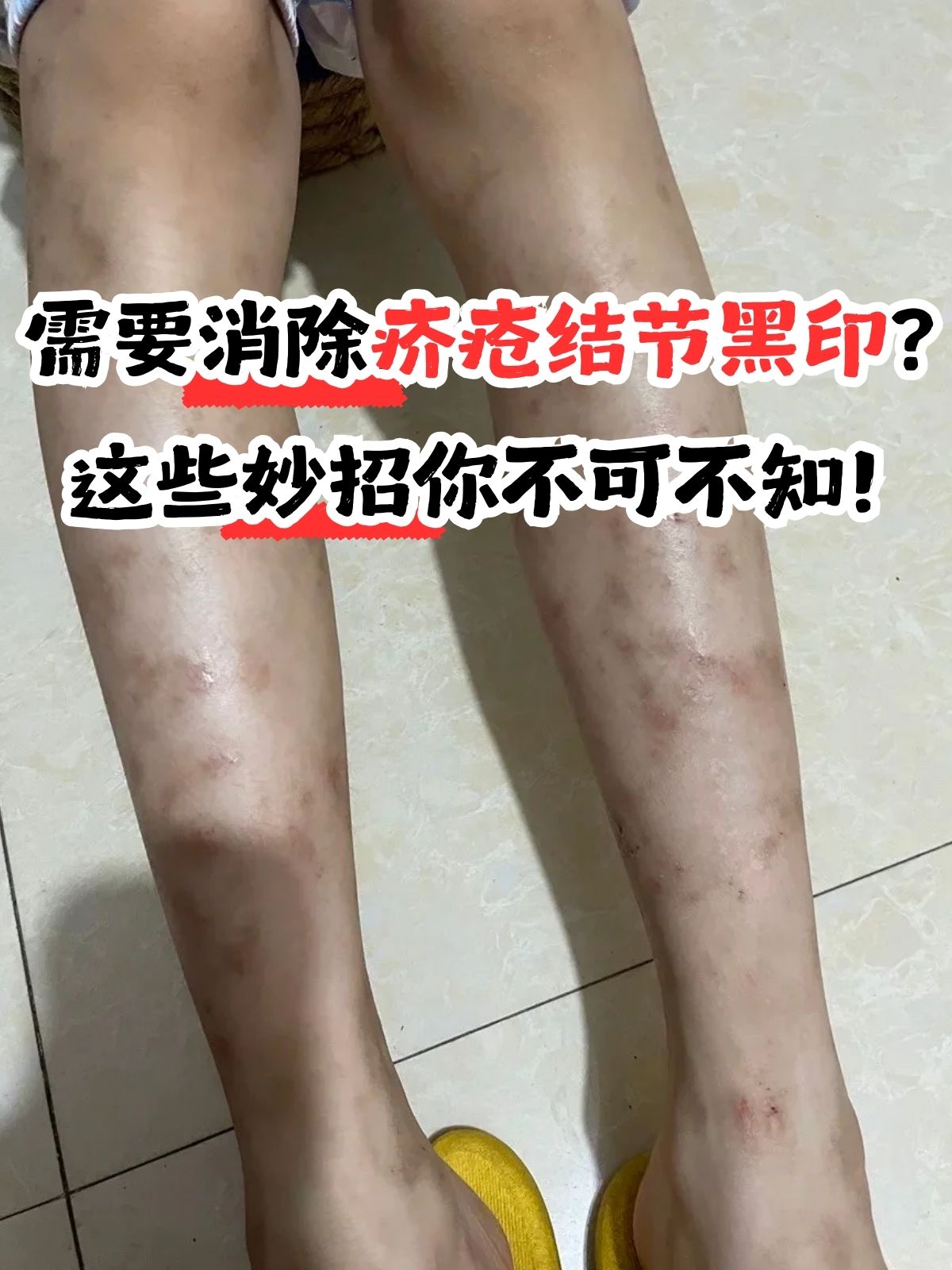 治疗疥疮的最好办法