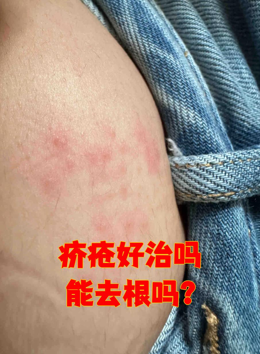 治疗疥疮的最好办法