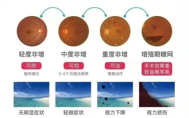 高血压视网膜病变分级