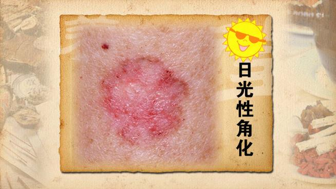 什么是日光性皮炎?