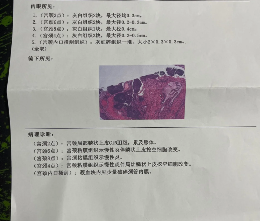 宫颈浸润性鳞状细胞癌严重吗