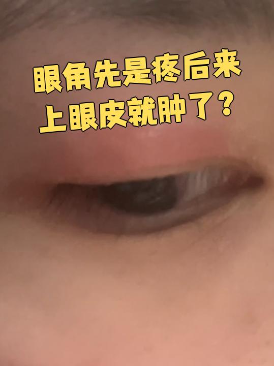 眼角疼是什么回事?