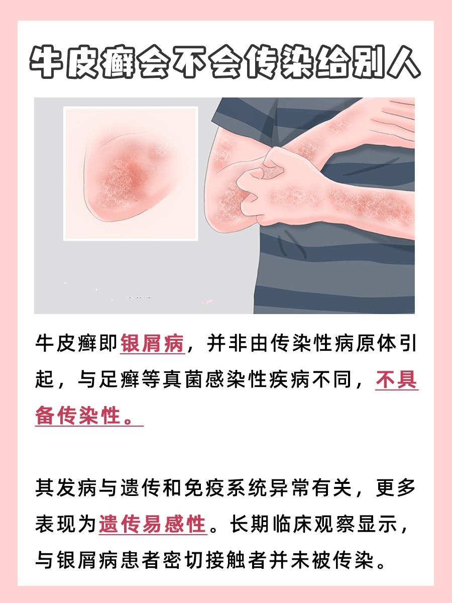 牛皮癣有传染性吗