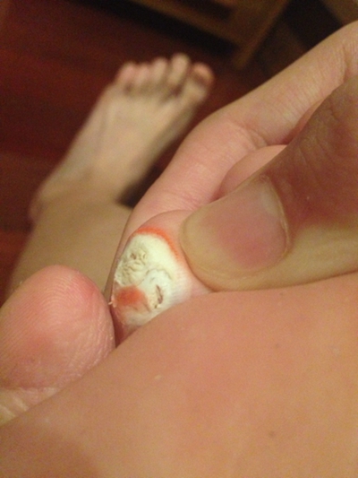 请问这样子鸡眼根算拔出来了吗