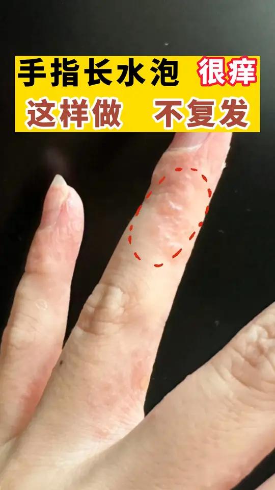 手长水泡怎么办?