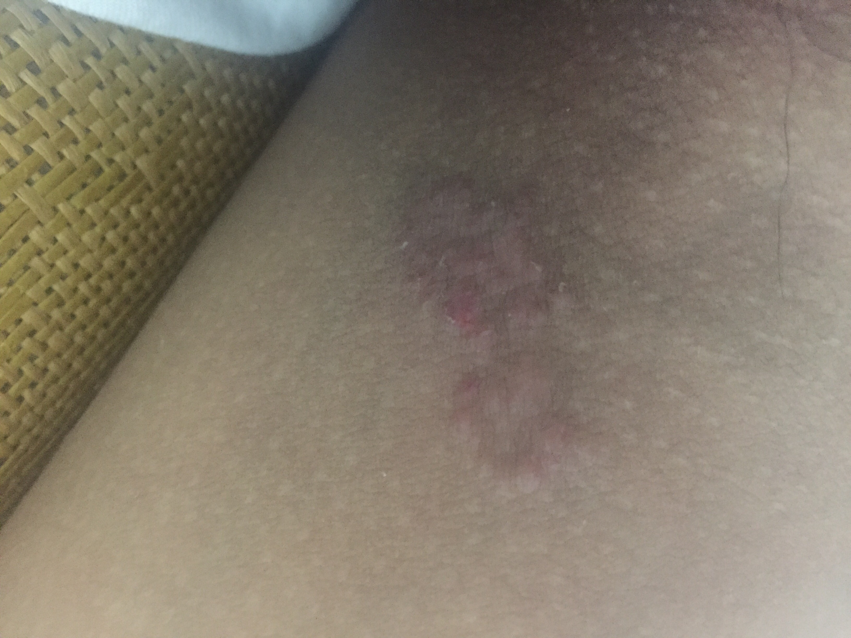 男,23岁.大腿根部瘙痒如图