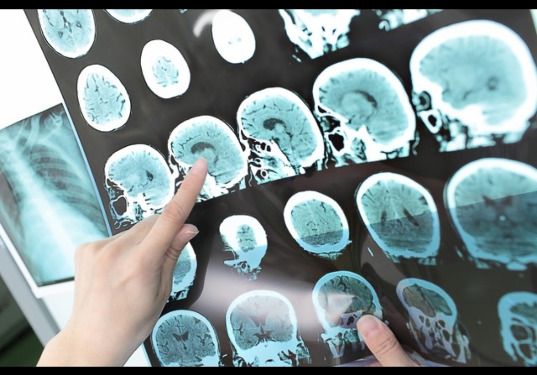 脑部CT,能检查出什么?谢谢