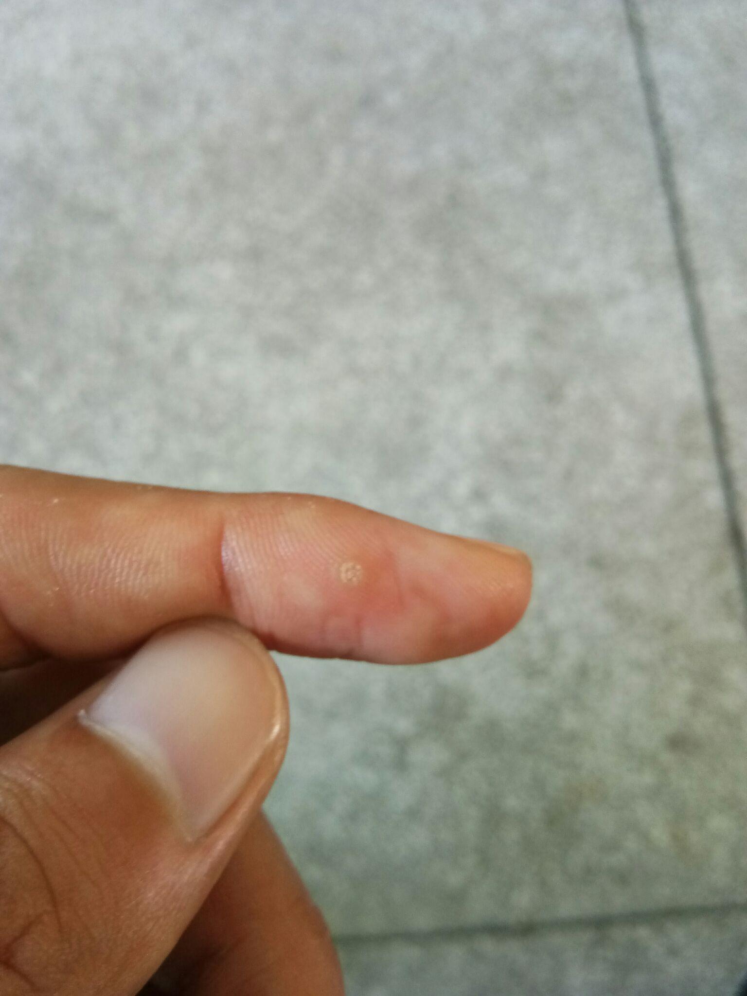 手指头长有肉刺一样的东西是什么