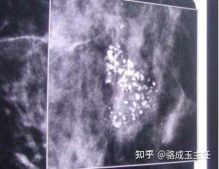 乳房钙化灶是什么意思