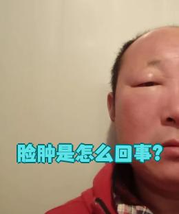 脸部浮肿是怎么回事