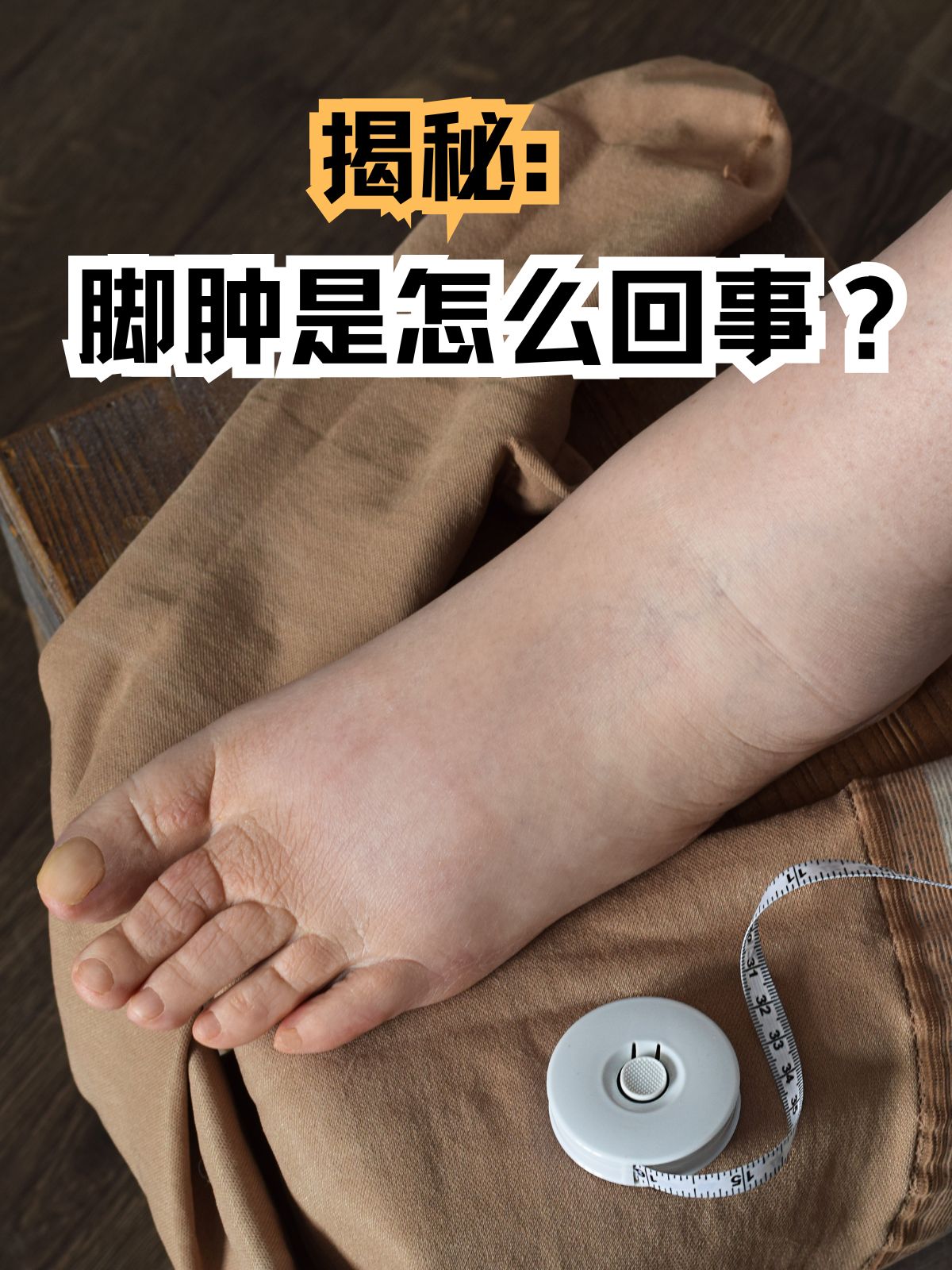 糖尿病脚肿是怎么回事