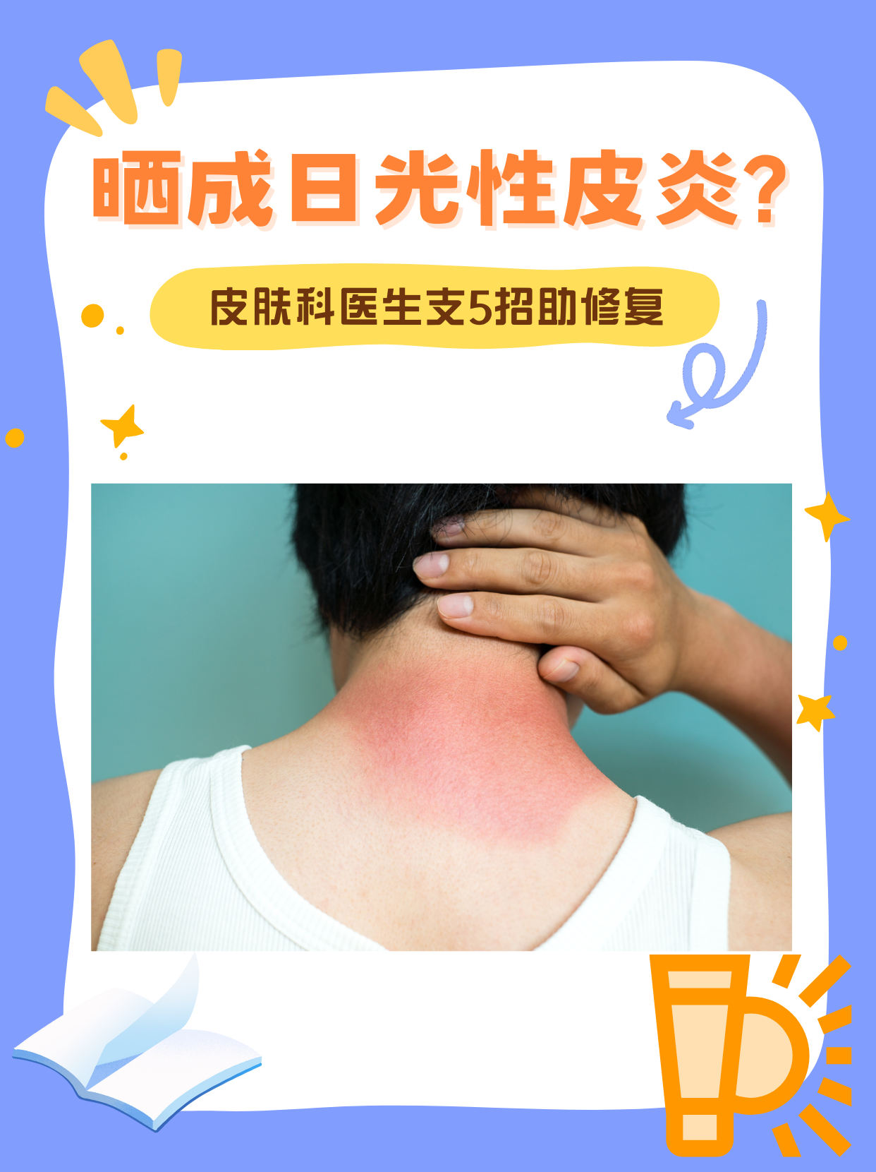 日光性皮炎怎么治?