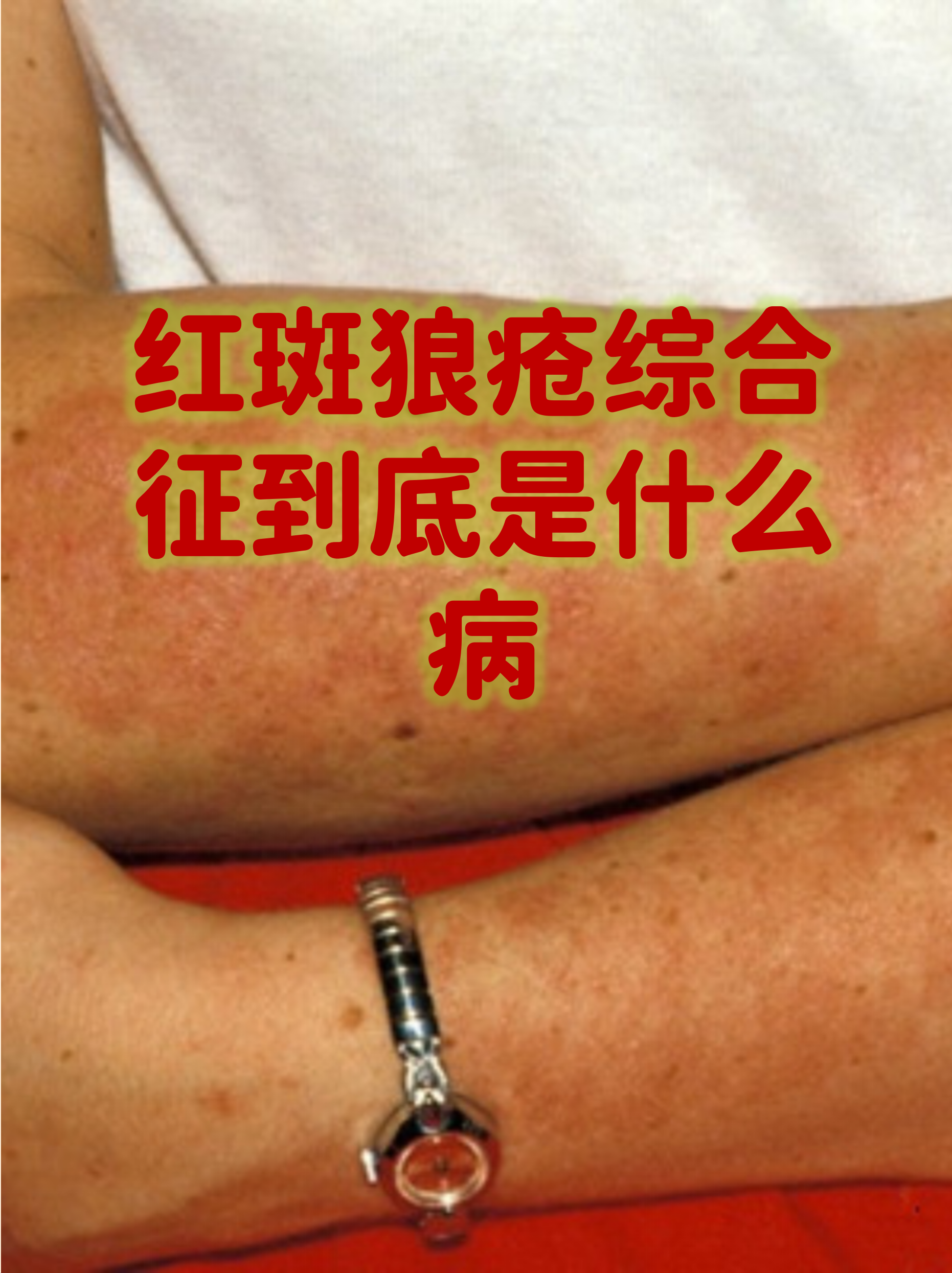 红斑狼疮脸部特点是怎样的