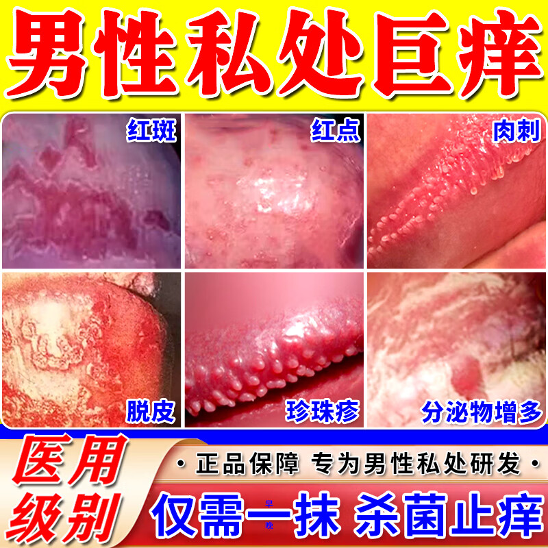 男性念珠菌感染用什么药治疗?