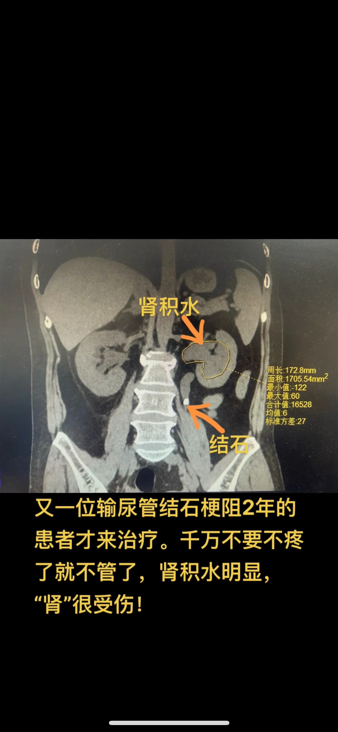 肾结石比肾积水严重吗