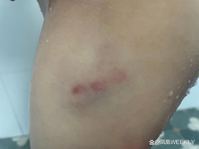 被狗咬到没有牙印没有血要怎么办呢我很怕会有病