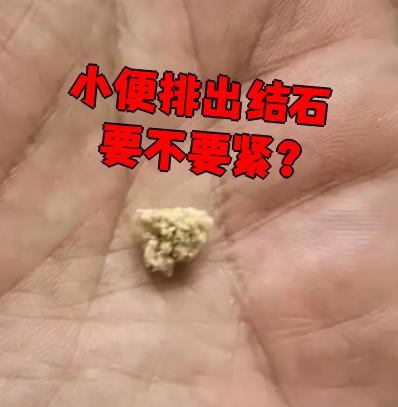 尿结石会很严重吗