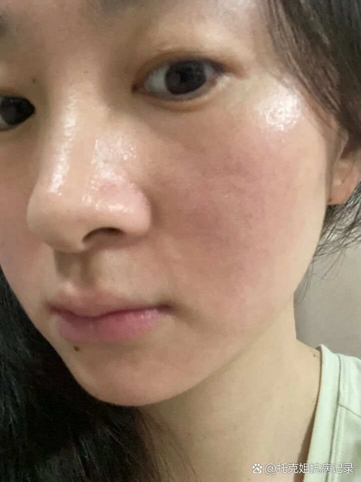 脂溢性皮炎可以治愈吗?