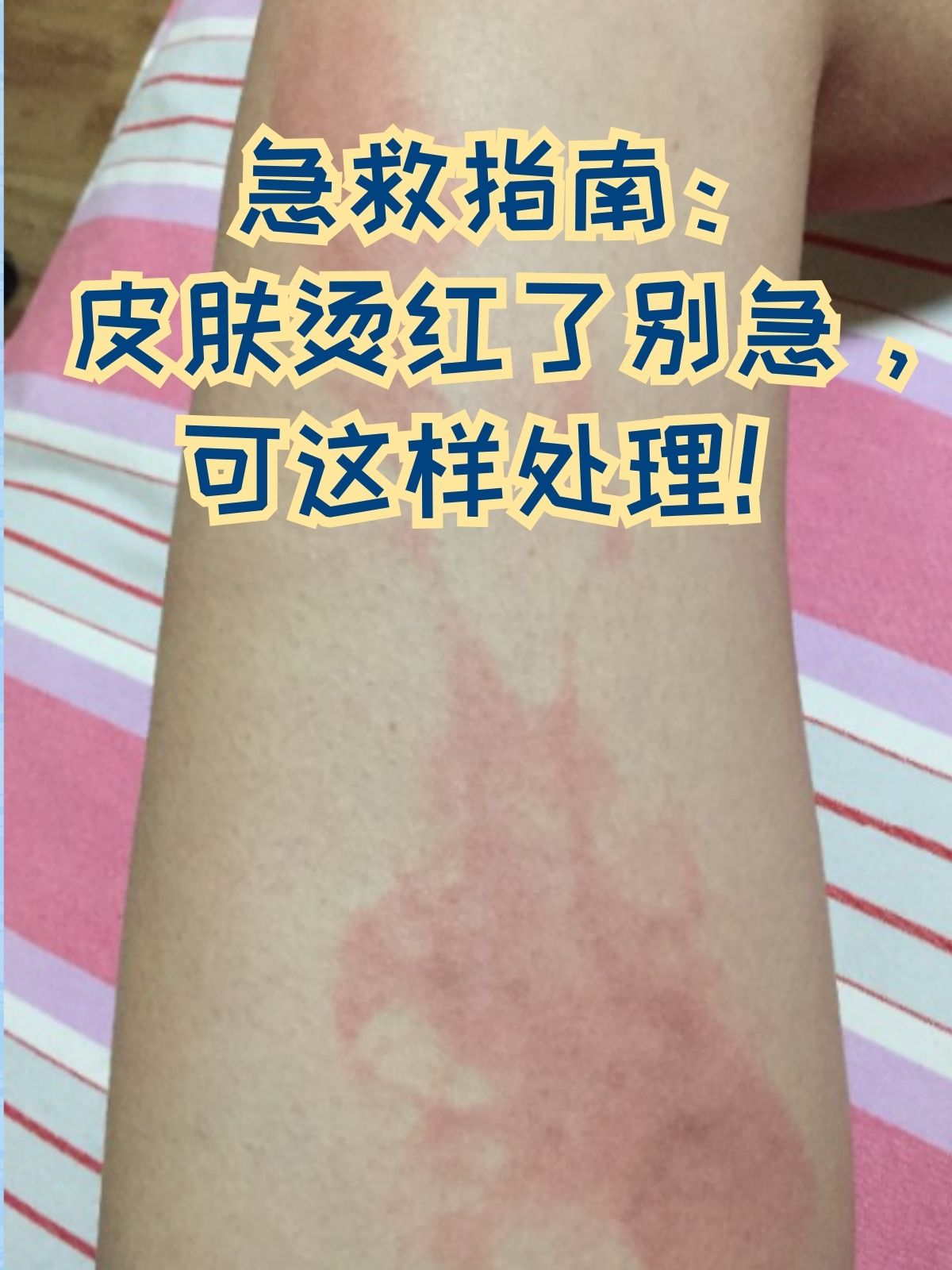 开水烫伤怎么办如何处理?