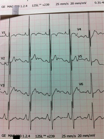 预激综合症心电图
