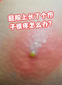 屁股长了个包一按就疼如何止痛