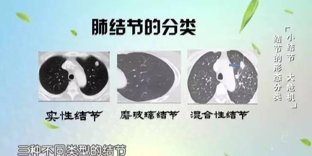 肺癌的类型有几种