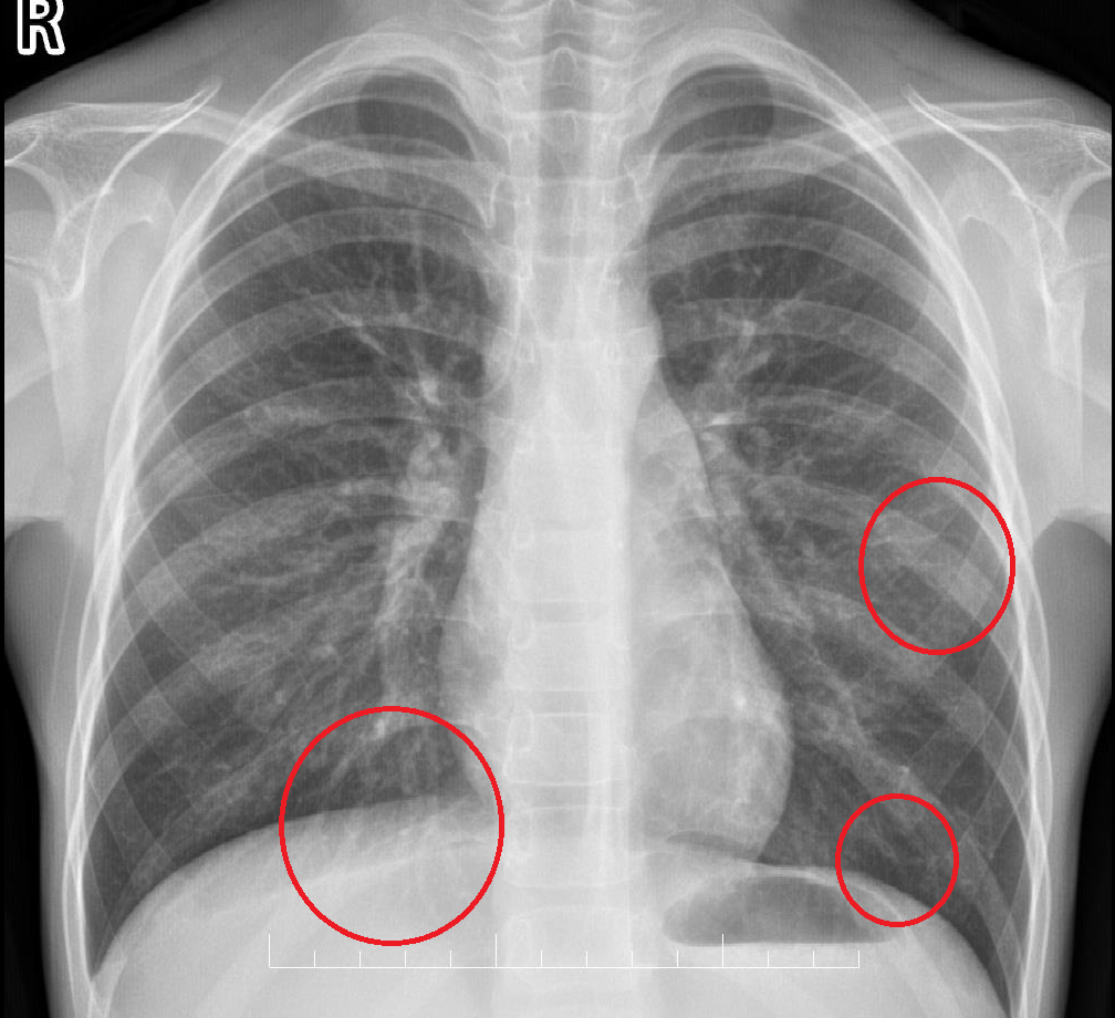 肺部阴影是什么