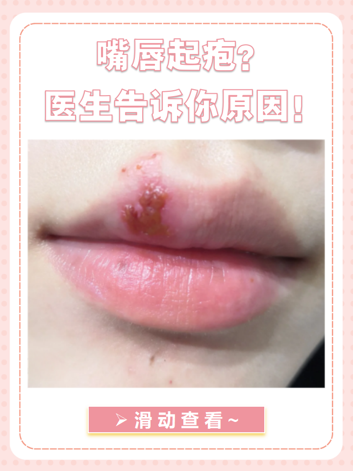 嘴角疱疹怎样痊愈最快