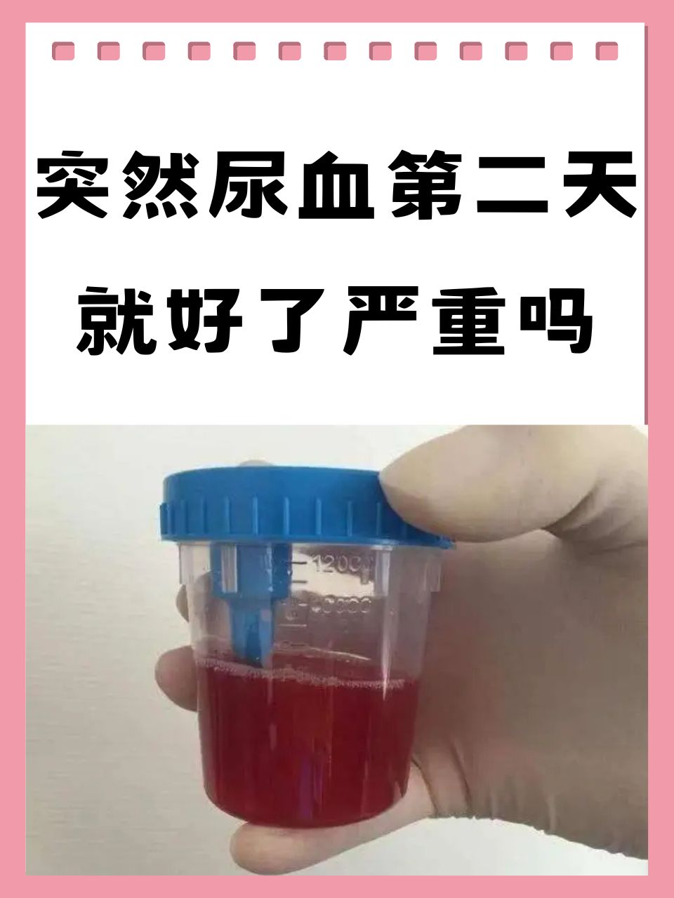 突然发现尿血,是怎么回事