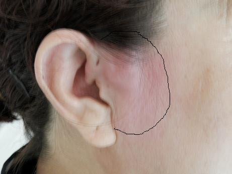 淋巴结肿大,好像在耳垂下方两厘米左右