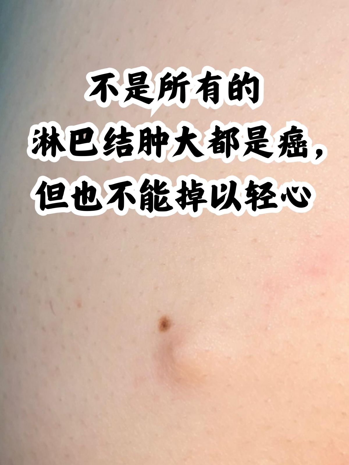 淋巴瘤早期能治好吗