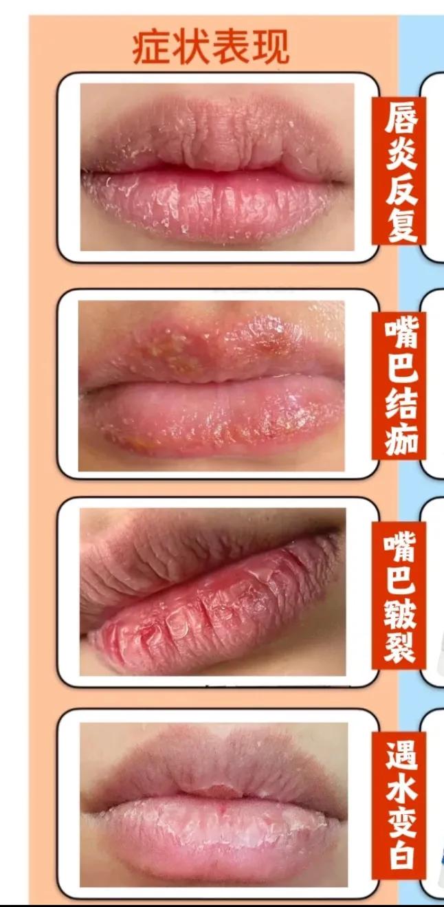 唇部脱皮怎么办