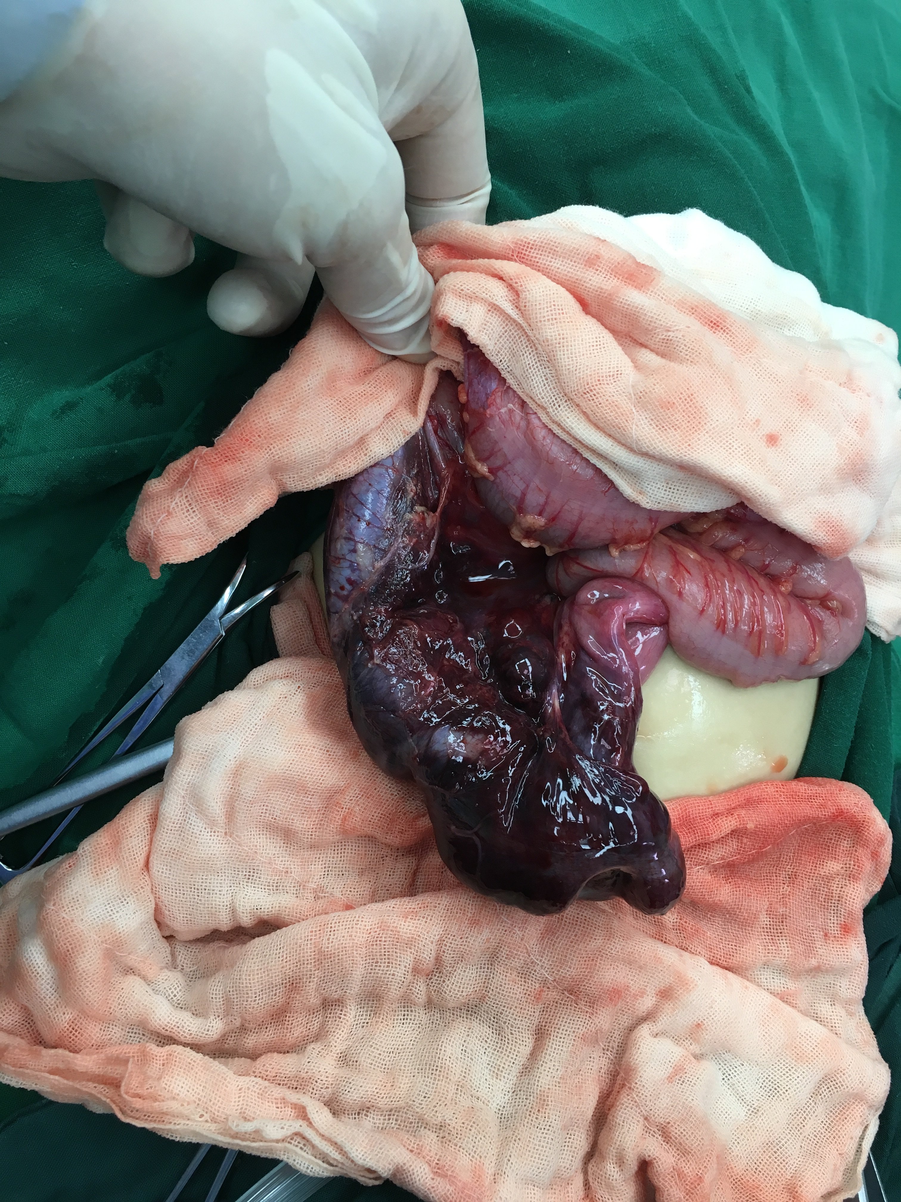 婴儿肠套叠什么症状表现?