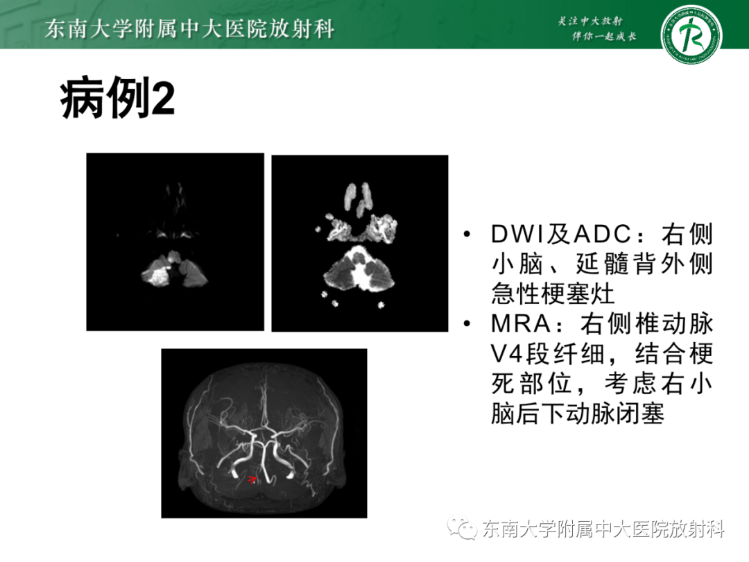 基底动脉尖综合征危险吗