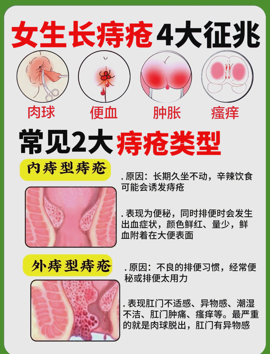 痔疮有哪些症状表现