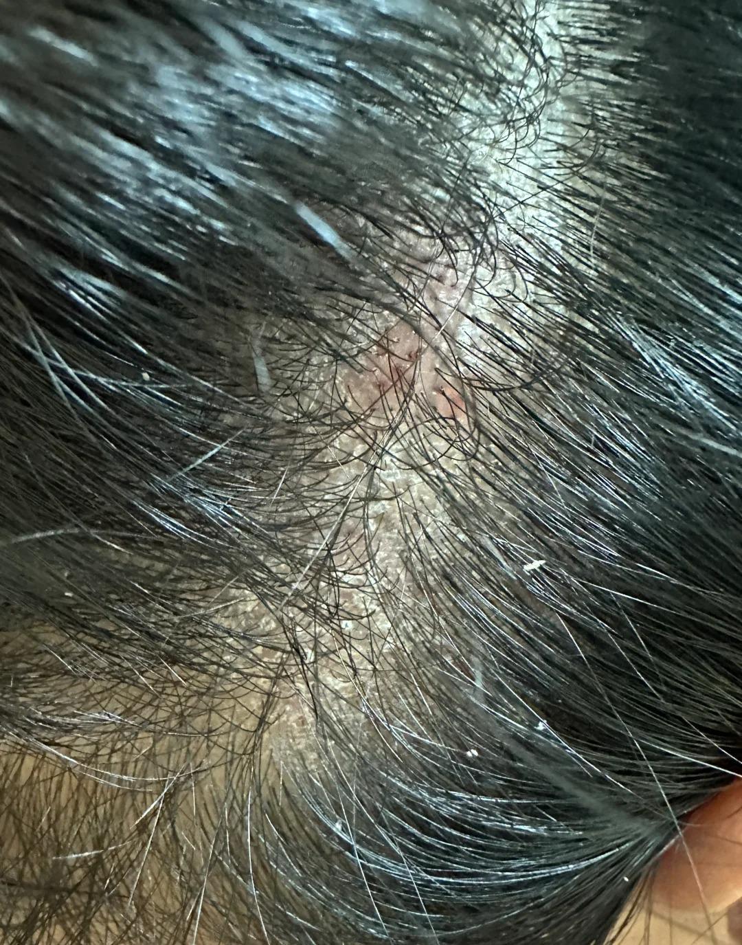 头屑是怎么产生的