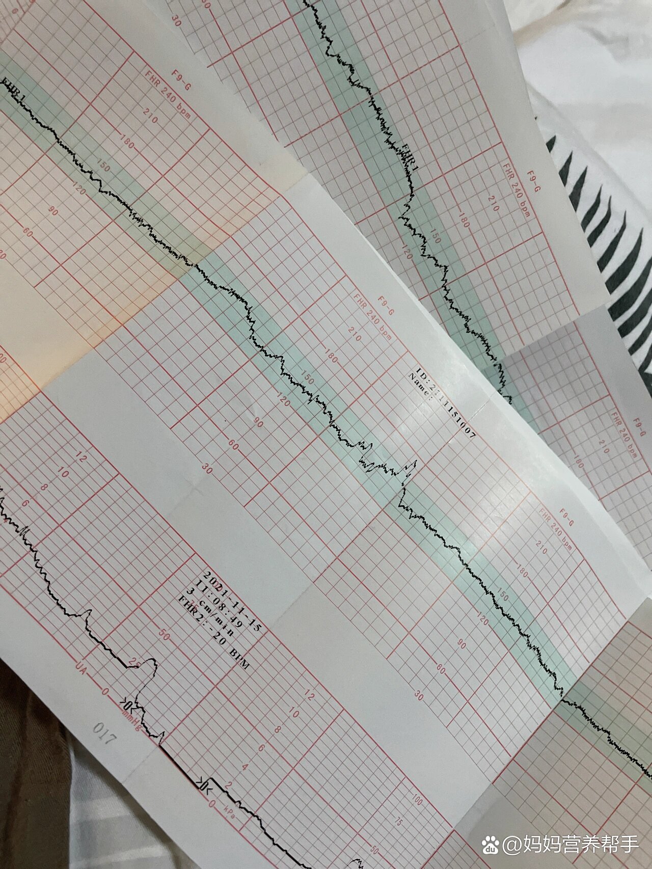 什么是胎心监测