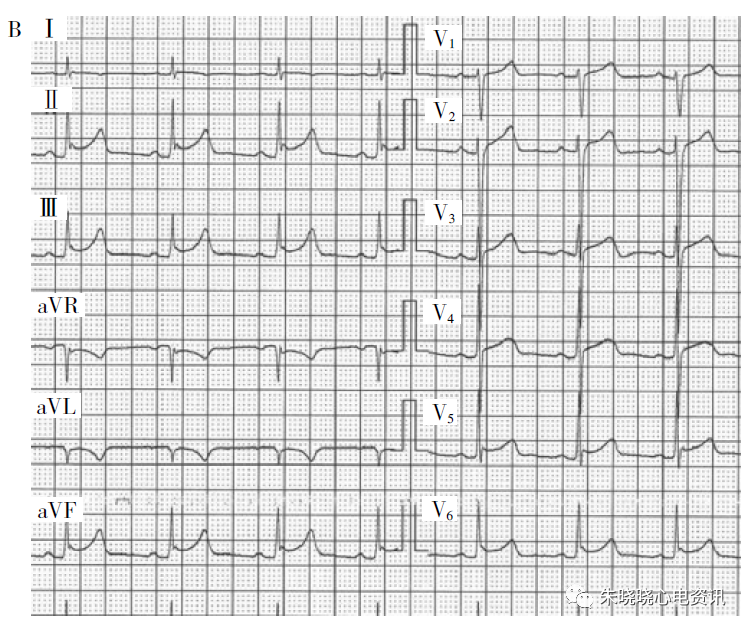 st段抬高是什么意思