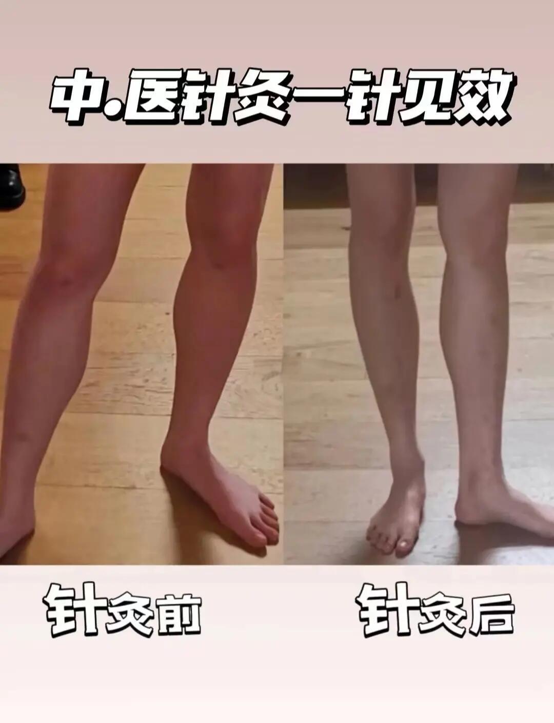 下肢水肿怎么办