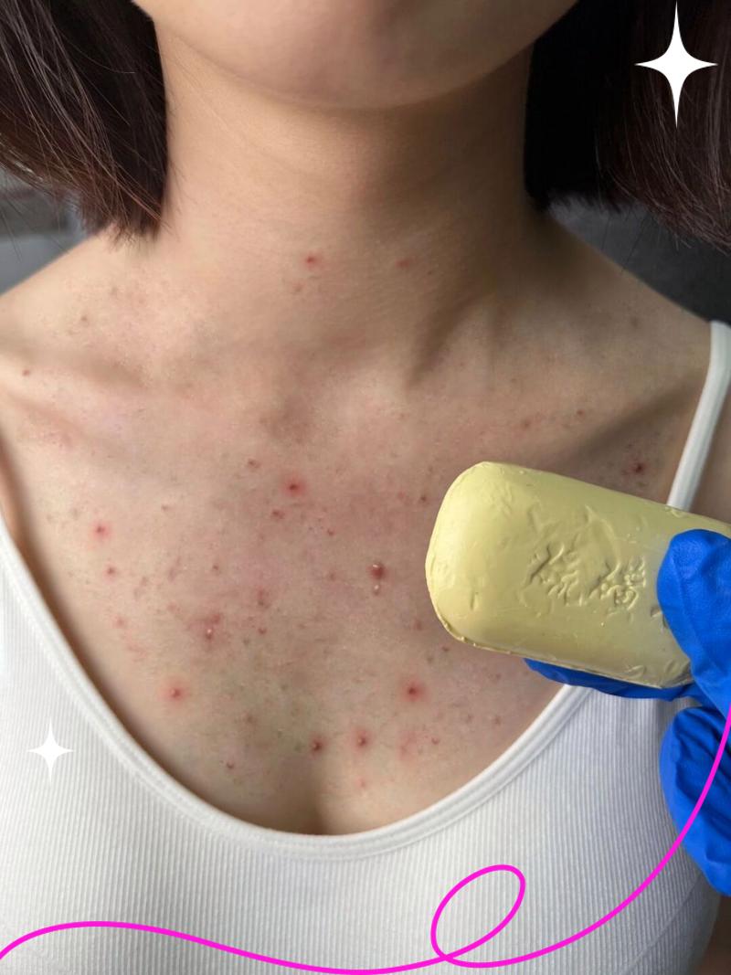 胸口长痘痘是怎么回事