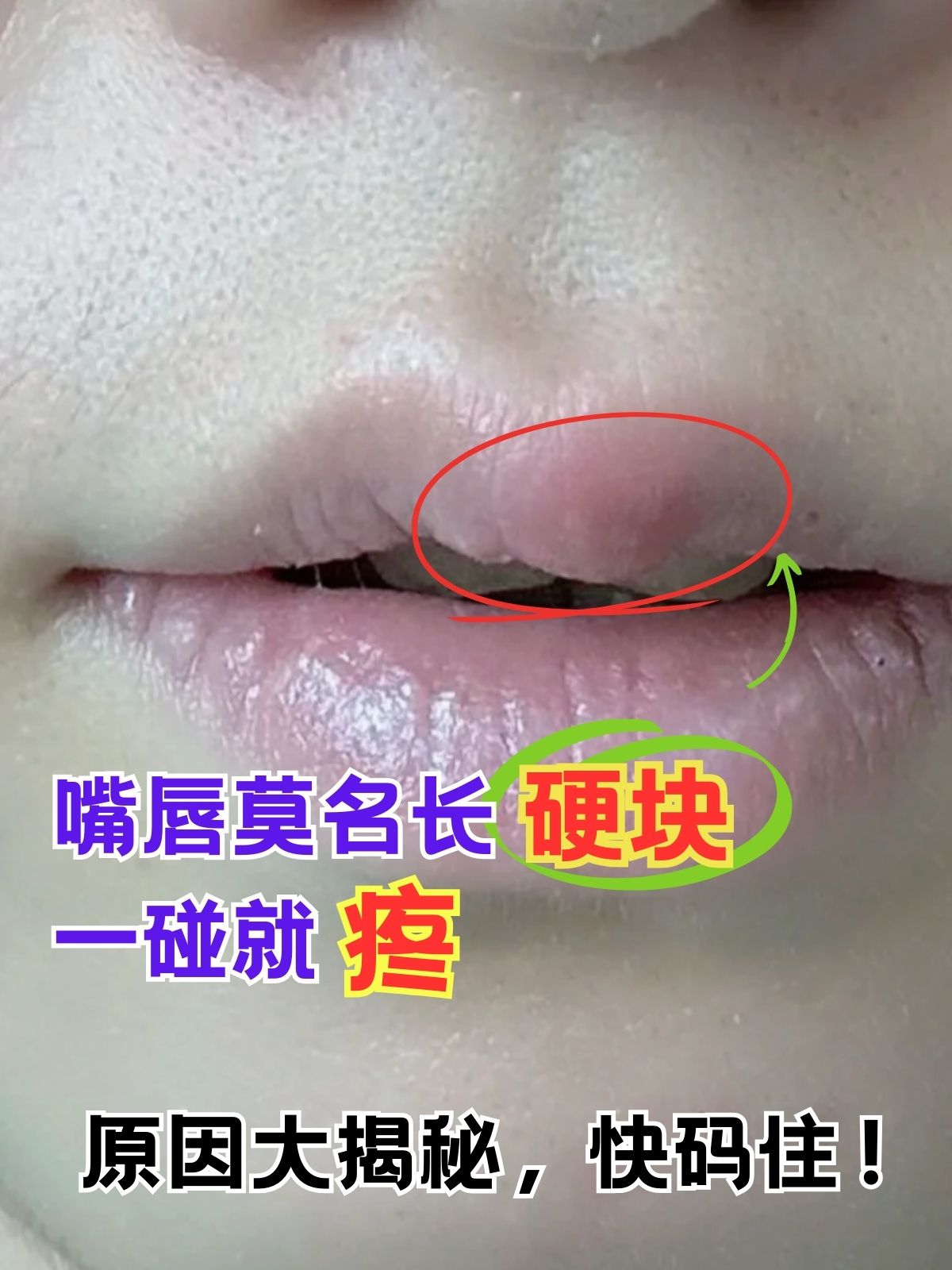 上嘴唇肿了怎么回事