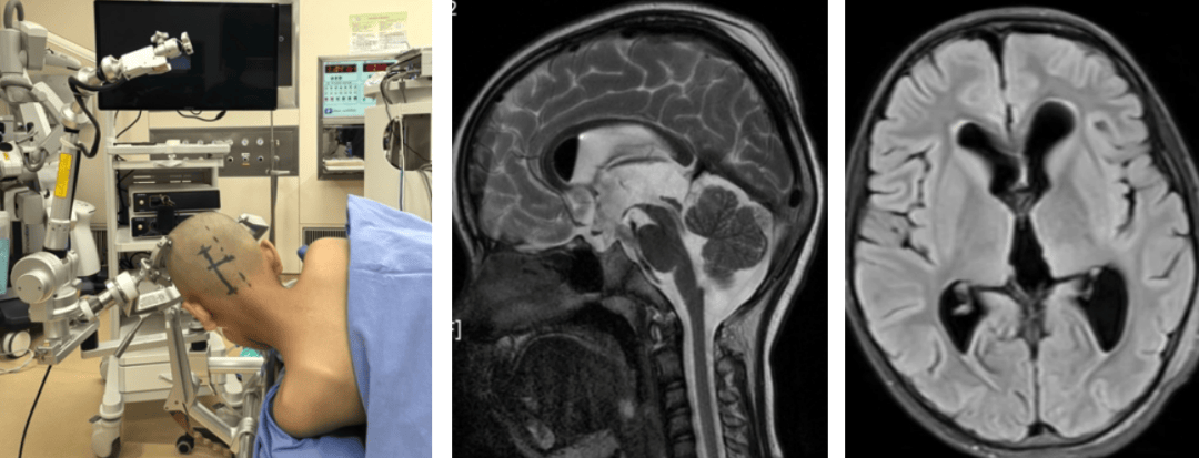 我女儿都了松果体囊肿,请问医生..