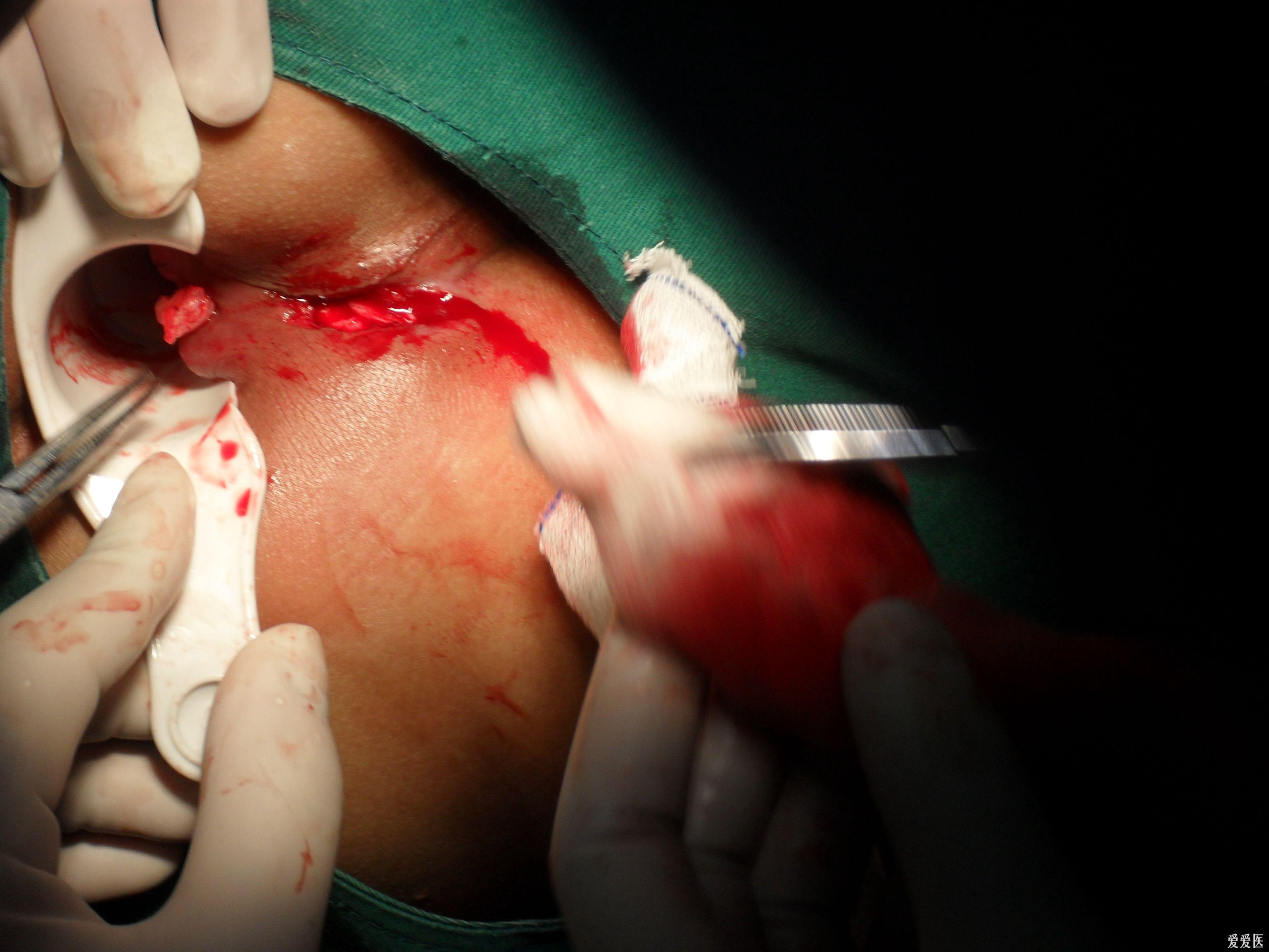 低位肛瘘切除10天左右