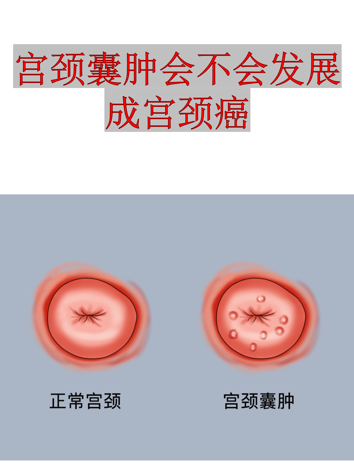 宫颈腺囊肿是怎么回事?